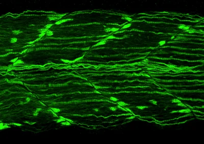 Myofibrillar myopathy image